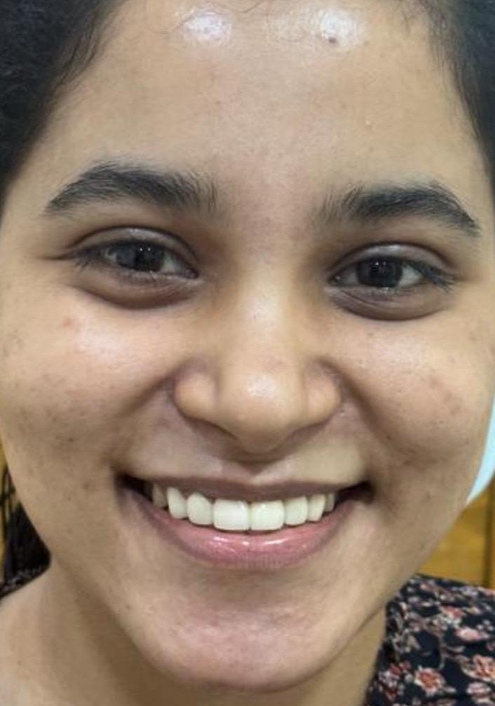 After smile makeover