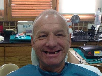 Basal implants before