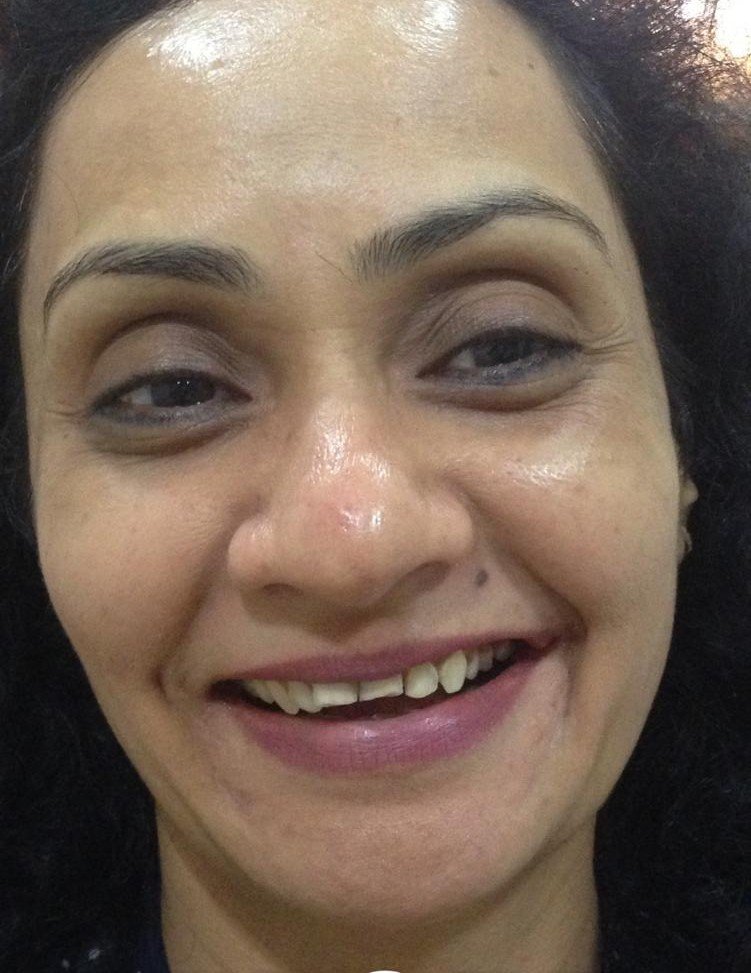 Before smile makeover