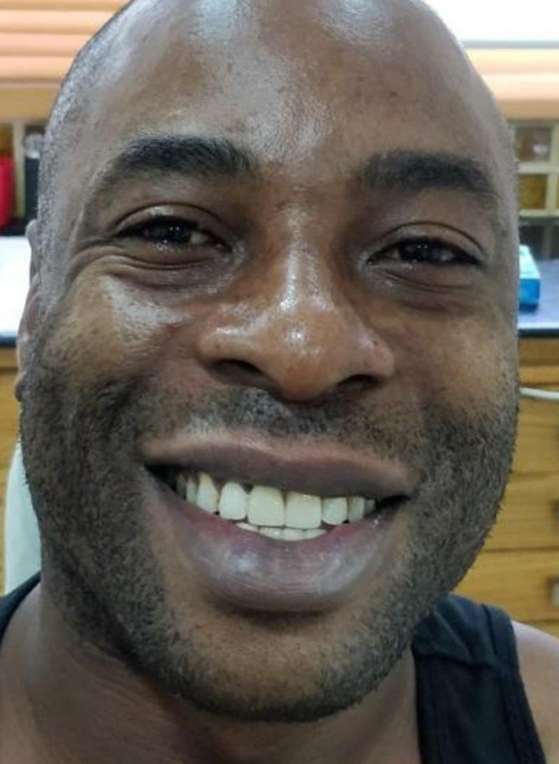 After smile makeover