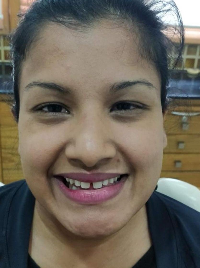 Before smile makeover