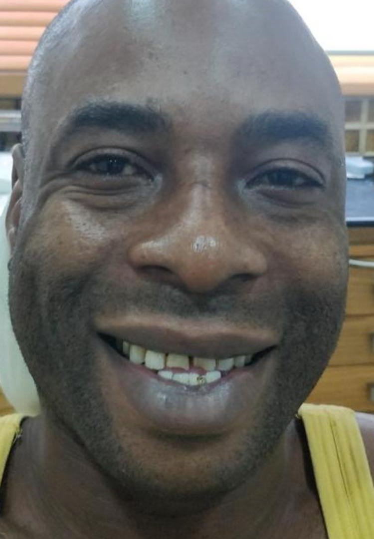 Before smile makeover